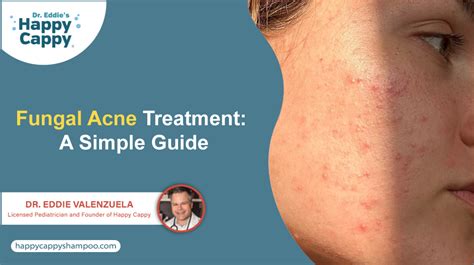 Fungal Acne Treatment: Expert Tips & Remedies 2025 - balustradellc