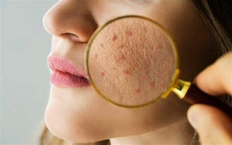Fungal Acne Treatment at Home in 2025: Complete Guide - balustradellc