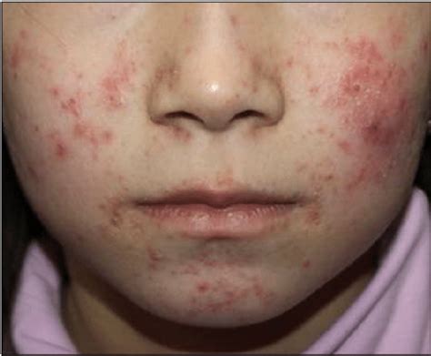 Face scabies. .  ...