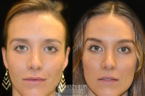 Facelift, Rhinoplasty, Brow & Neck Lift - Facial Plastic Surgeon