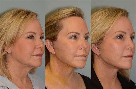 Facelift and Neck Lift Before & After Gallery London