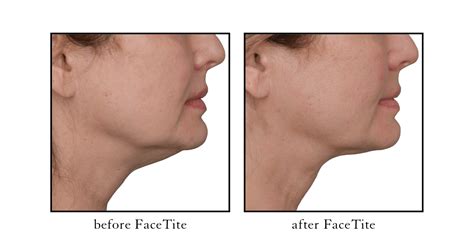 Facetite procedure near me.  Find experienced InMode providers near you.  Overse...