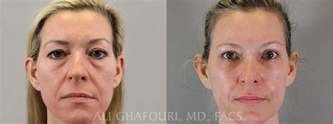 Facial Fat Grafting Atlanta GA - ME Plastic Surgery