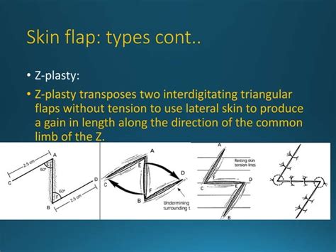 Facial flaps.  Although geometric flaps are The texture, colour and con...