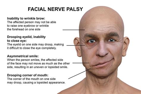 Facial nerve paralysis - Wikipedia