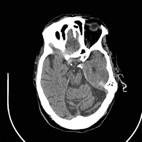 Fahr disease Radiology Case Radiopaedia.org