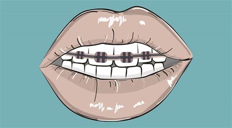 Fake Dental Braces popular in Thailand. - Thai residents