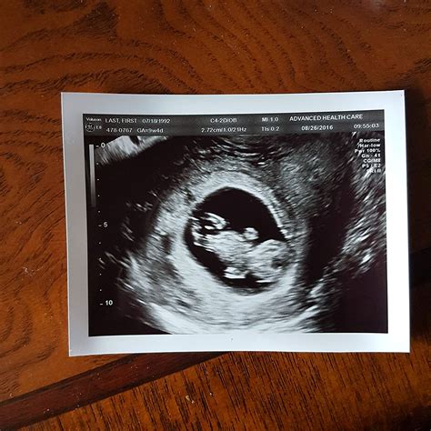 Fake ultrasound pics. 2D Fake Ultrasound Sonogram with Personalization! 14 product reviews. $99.95 $19.95. (You save $80.00) Weight: 1.00 LBS. Shipping: Calculated at checkout. Patients Name (Example: Doe, Jane Last, First): 