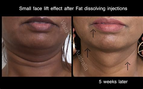 Fat Dissolving Injections Price
