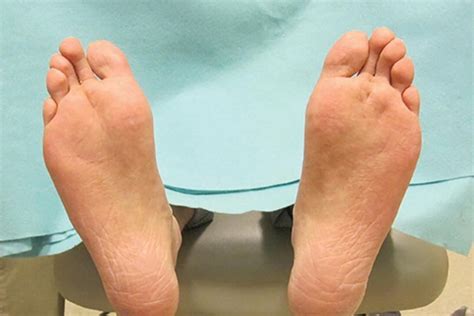 Fat Pad Atrophy of the Foot - The Center for …