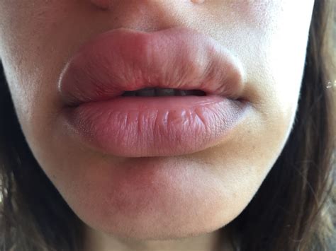Fat lip. Things To Know About Fat lip. 