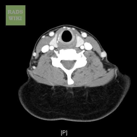 Fat redistribution syndrome Radiology Reference Article …