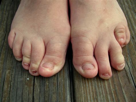Fat ugly feet. Lipedema is a relatively common fat disorder that is often mistaken for simple obesity. Its clinical diagnosis is an adipose tissue disorder or a lipid metabolism disorder. A typical lipedema patient is a woman who struggles with large hips and legs, usually out of proportion to the rest of her body. Lipedema also appears in the upper arms. 