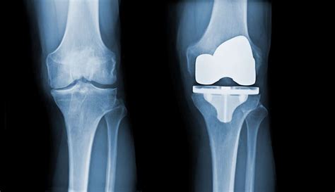 Fda knee replacement recalls.  Exactech originally recalled polyethylen...