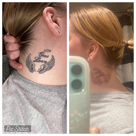 Feeling ill after laser removal session : r/TattooRemoval - Reddit