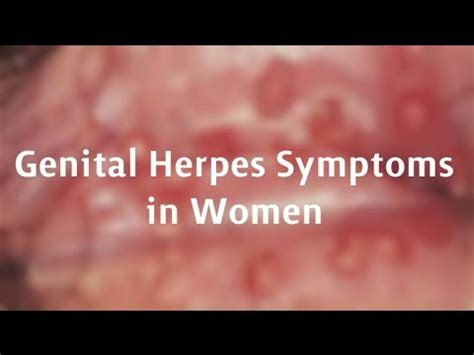 Genital Herpes Symptoms in Men. Genital herpes symptoms in men can include: Blisters or sores that can break open on the genitals, anus, or mouth. A smelly discharge from the urethra (the front of the penis) Flu-like symptoms like body aches, swollen nodes, and fever. Tingling around genitals. Burning around genitals.. 
