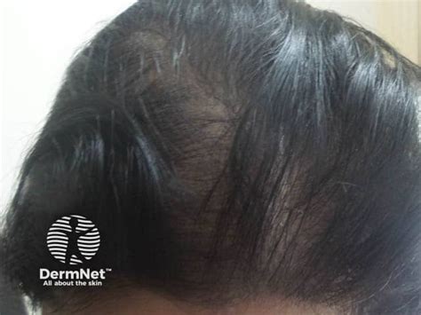 Female pattern hair loss DermNet