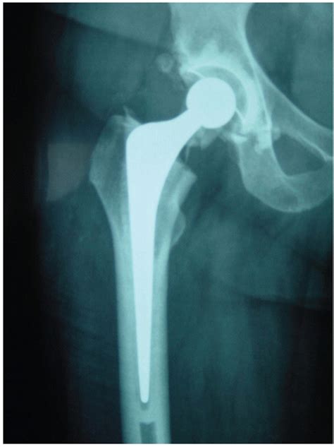 Femoral Neck Fracture - TeachMe Orthopedics