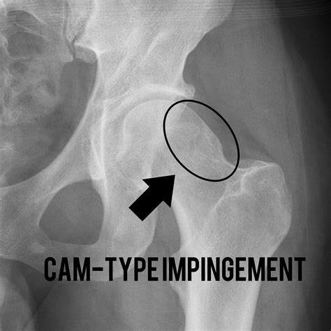 Femoroacetabular impingement (FAI) represents an underlying bony abnormality of either the femoral head-neck junction or acetabulum, or most commonly, both. This often is associated with damage to intra-articular structures, primarily the labrum and chondral surfaces. Like pincer impingement, cam impingement has been associated with pain .... 