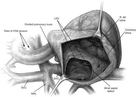 Fenestrated Fontan Procedure Operative Techniques in Cardiac and