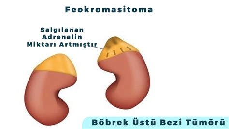 Feokromasitoma ATUDER.