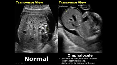 Fetal Bowel Ultrasound Normal Vs Abnormal Image Appearances