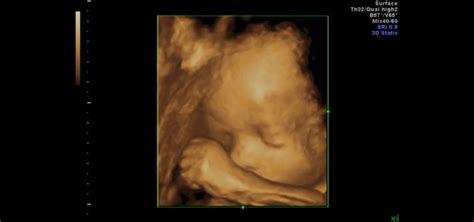 Fetal Sonographer at Cincinnati Children