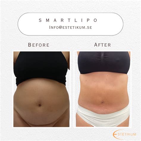 Fettsugning mage pris