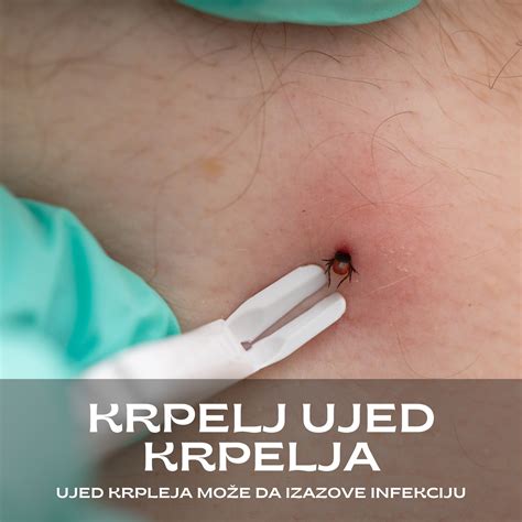 Fibrin na rani.  U neo&scaron;tećenoj koži, u epidermi (povr&scaron;inski ...