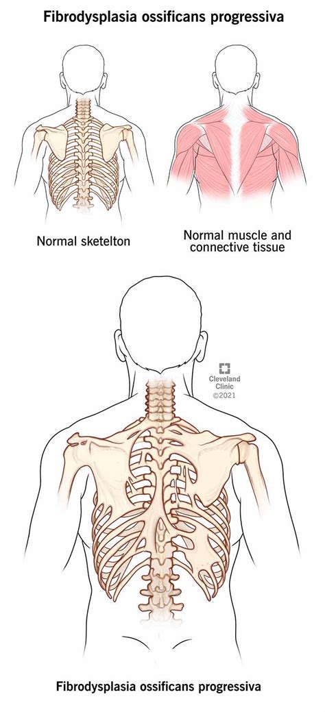 Fibrodysplasia Ossificans Progressiva (thing) - Everything2