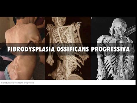 Fibrodysplasia ossificans progressiva (FOP) Ada