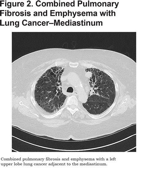 Fibrosis with emphysema - PubMed