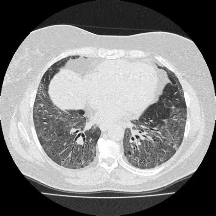 Fibrotic non-specific interstitial pneumonitis - Radiopaedia