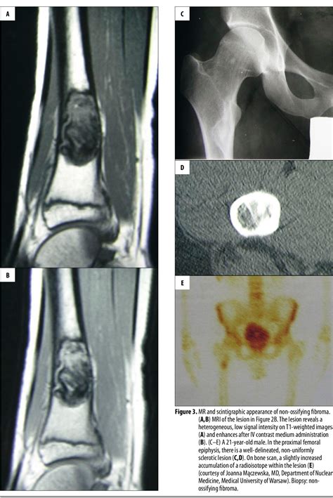 Fibrous Cortical Defect and Nonossifying Fibroma Imaging