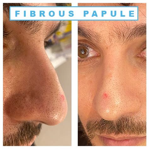 Fibrous papule of the nose removal at home. 