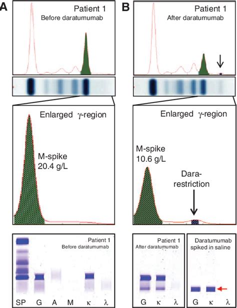 Figure 1 from Interference of daratumumab in monitoring multiple