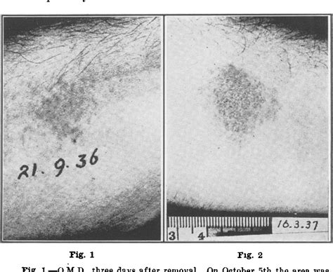Figure 1 from Prevention of Poison Ivy Dermatitis by the Intramuscular