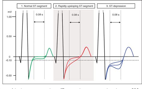 Figure 1 from Rapidly upsloping STsegment on exercise ECG a marker of