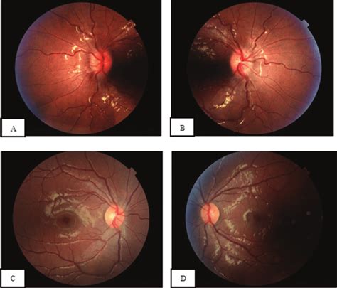 Figure1-Fundus photography of the right (A) and left (B