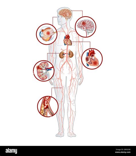 File : Main complications of persistent high blood pressure.svg …