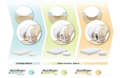 Finceramica regenerative surgery - Maioregen osteochondral …