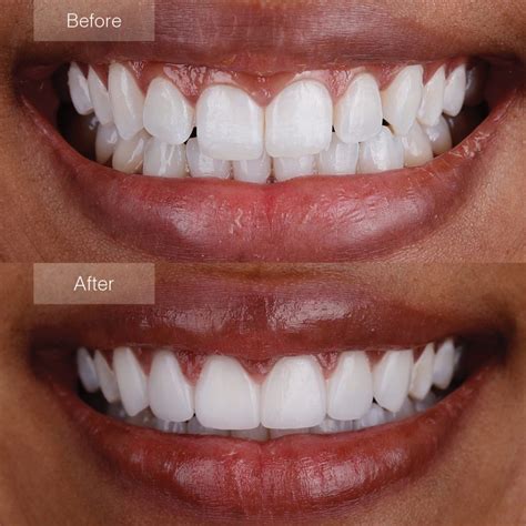 Find Veneers Treatment Near Lafayette, CO Opencare.com