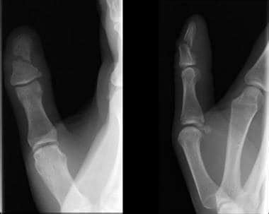 Finger and Thumb Injury Imaging: Practice Essentials, Radiography ...