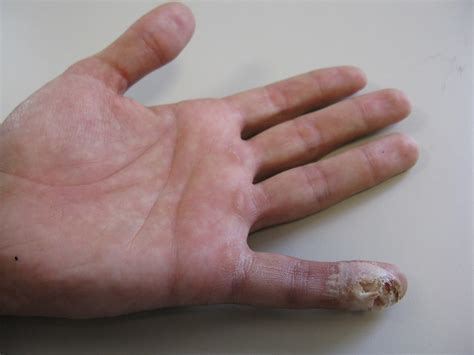 Finger rotten. Some reasons your fingers may swell include heavy salt consumption, exercise, high temperatures, arthritis, overuse, or injury. Rarely, finger swelling is a sign of heart, liver or kidney failure, but these are chronic conditions accompanied by other symptoms and swelling that is worse in the legs. 