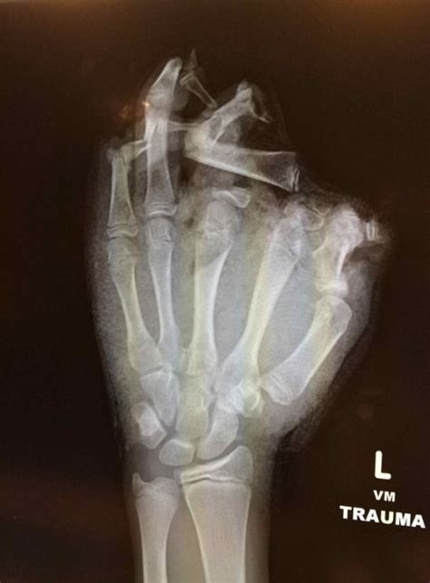 Fireworks injuries: ‘I have had a patient lose their entire hand’