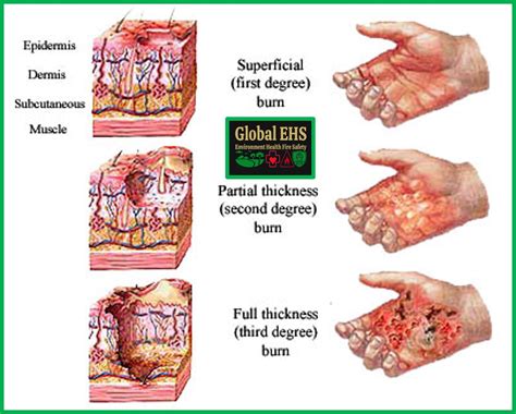 First Aid for Third-Degree Burns - EmpowHER