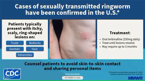 First Cases of Sexually Transmitted Ringworm Reported in the