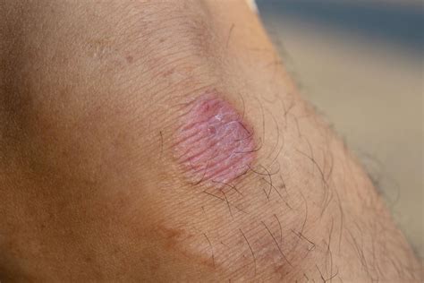 First-ever drug-resistant ringworm infections found in US: CDC