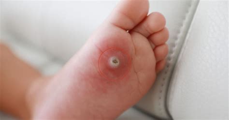 Fish eye foot removal.  Almost always successful, even when removing large fish hooks.  O...