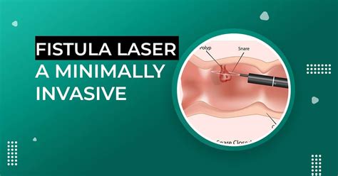 Fistula laser operation. .  ...